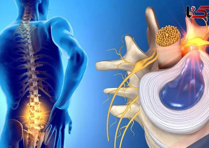 تأثیر استرس و اضطراب بر دردهای دیسک کمر