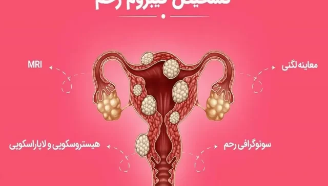 علائم و درمان فیبروم رحم در زنان